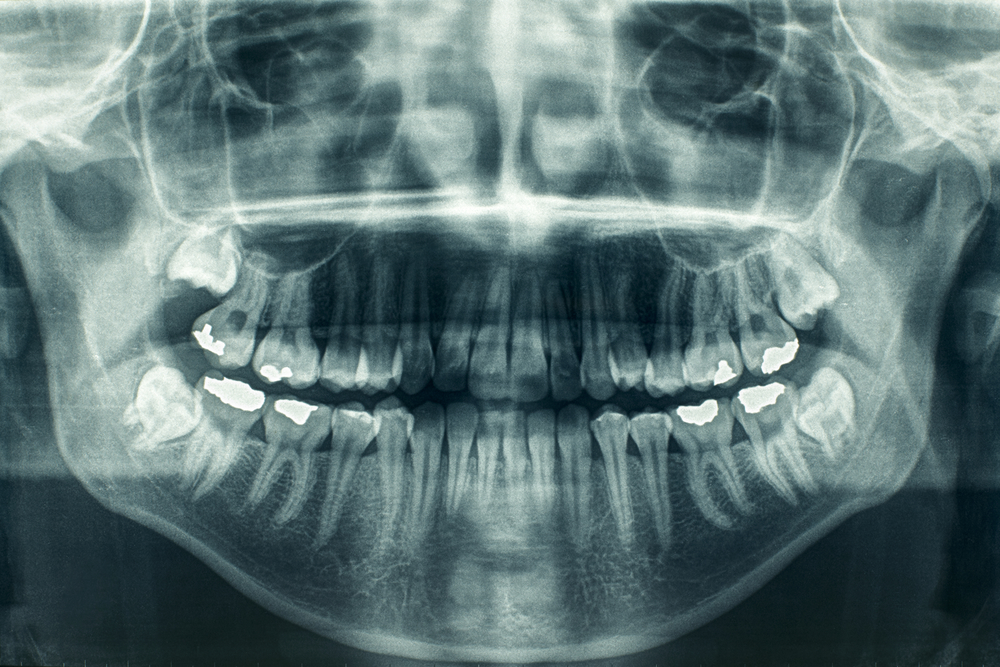 Dental X-Ray