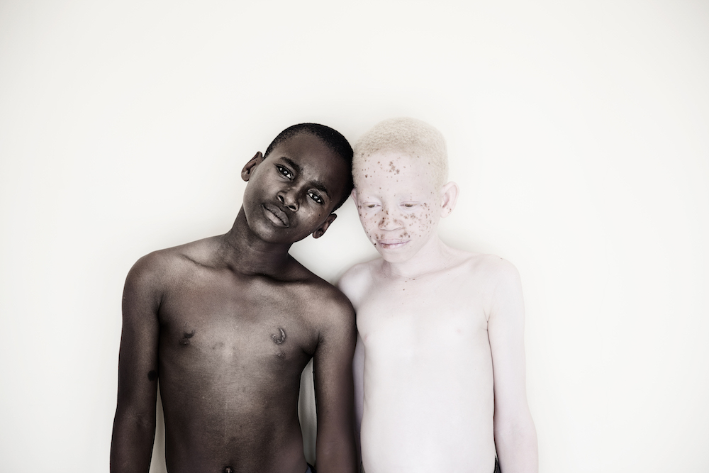 Under the Same Sun Albinism and breaking down superstitions Design
