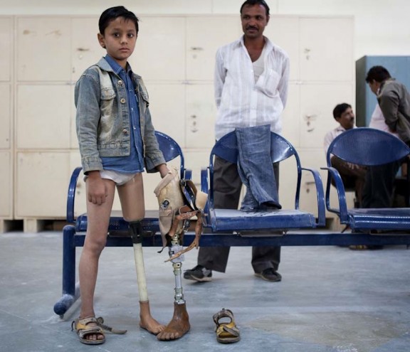 D-Rev, a company focusing on providing quality healthcare to low-income populations, is launching the ReMotion Knee. Image: Amin, who was fit with a Jaipur Knee in 2011