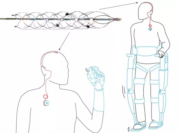 University of Melbourne brain implant