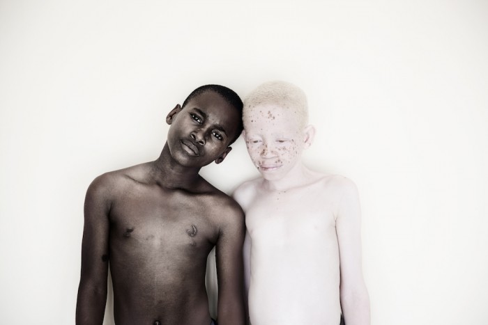 Under the Same Sun: Albinism and breaking down superstitions | Design ...