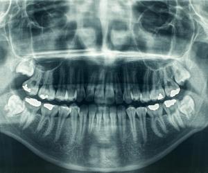 Dental X-Ray