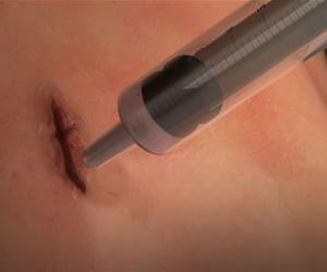 Super Surgical Glue