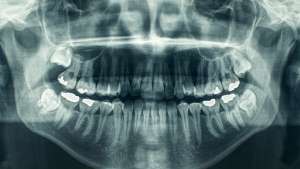 Dental X-Ray